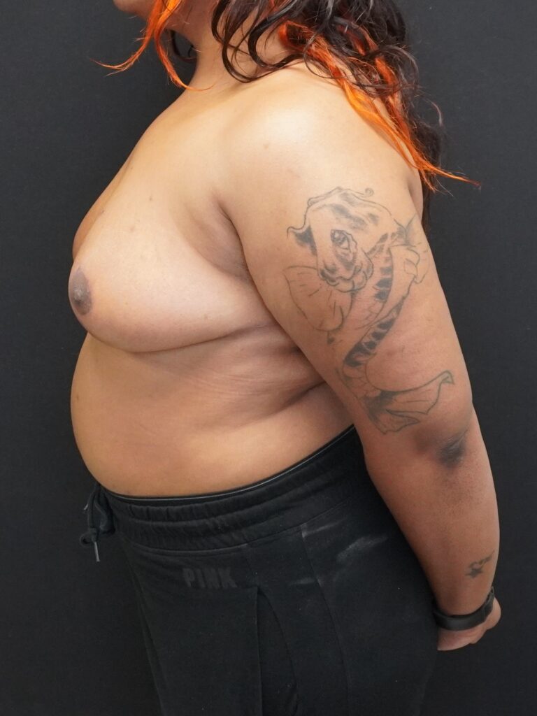 After Image:  - left-side