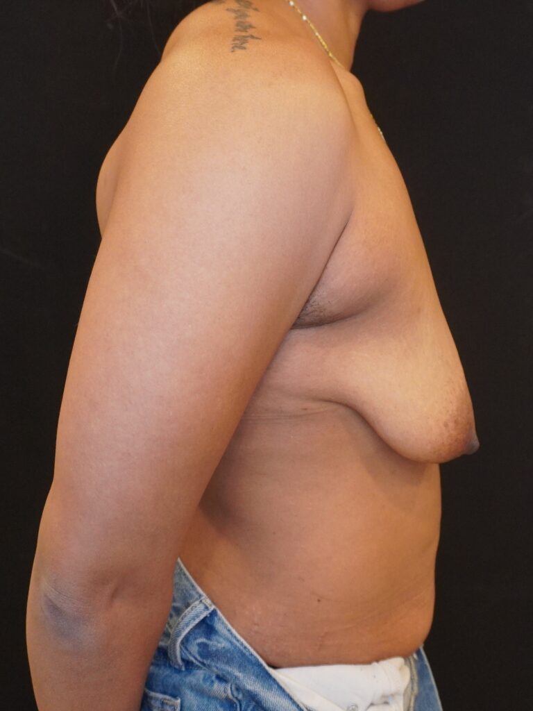 Before Image:  - right-side