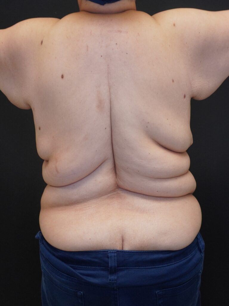 Before Image:  - back