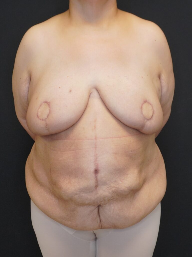 After Image:  - front