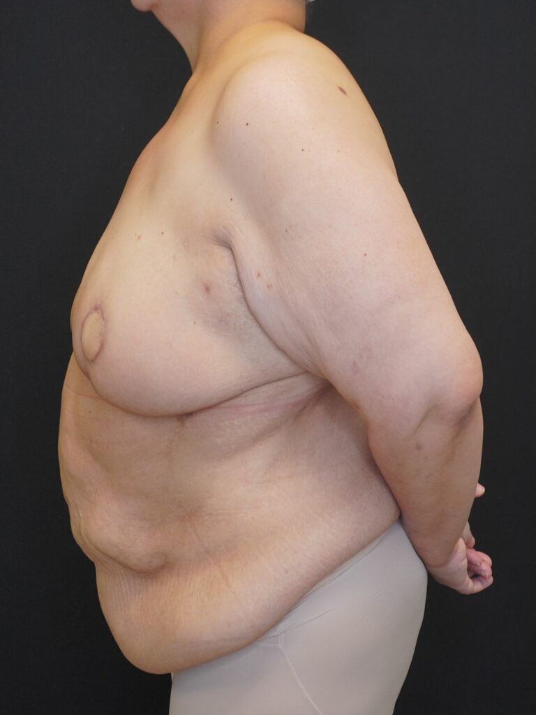 After Image:  - left-side