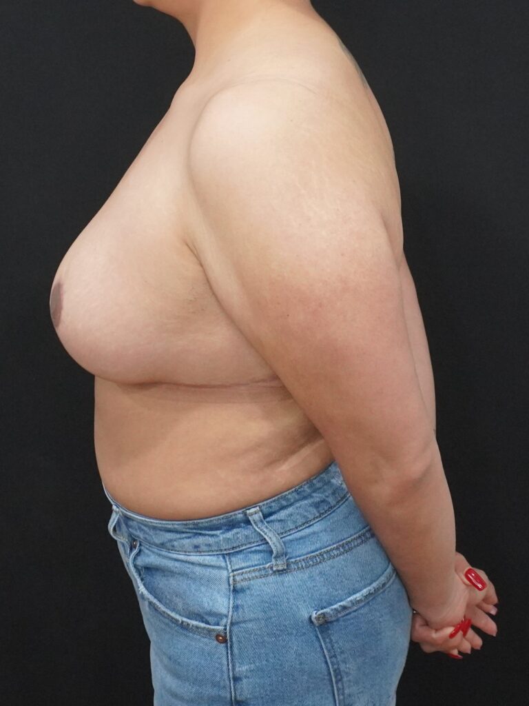 After Image:  - left-side