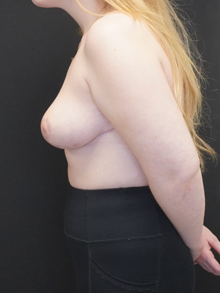 After Image:  - left-side