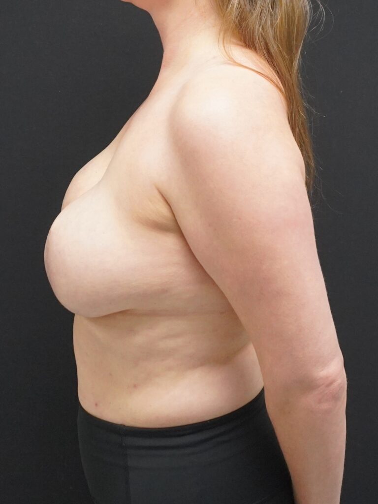 Before Image:  - left-side