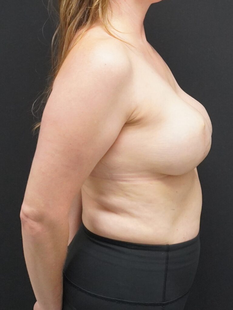 Before Image:  - right-side