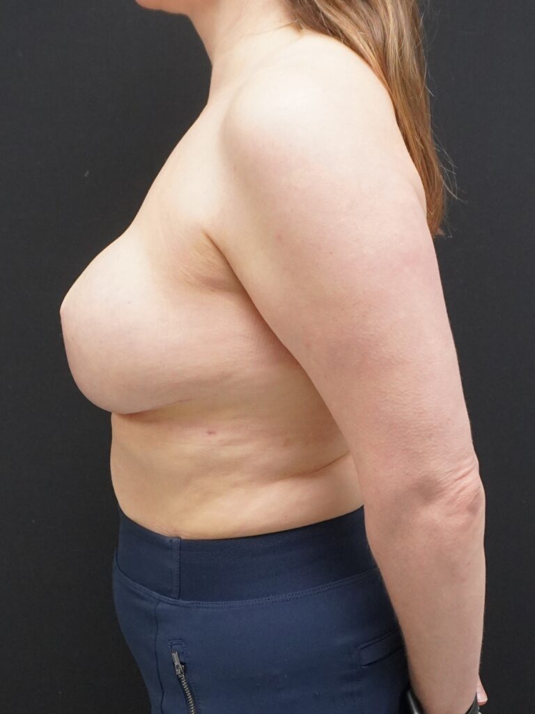 After Image:  - left-side