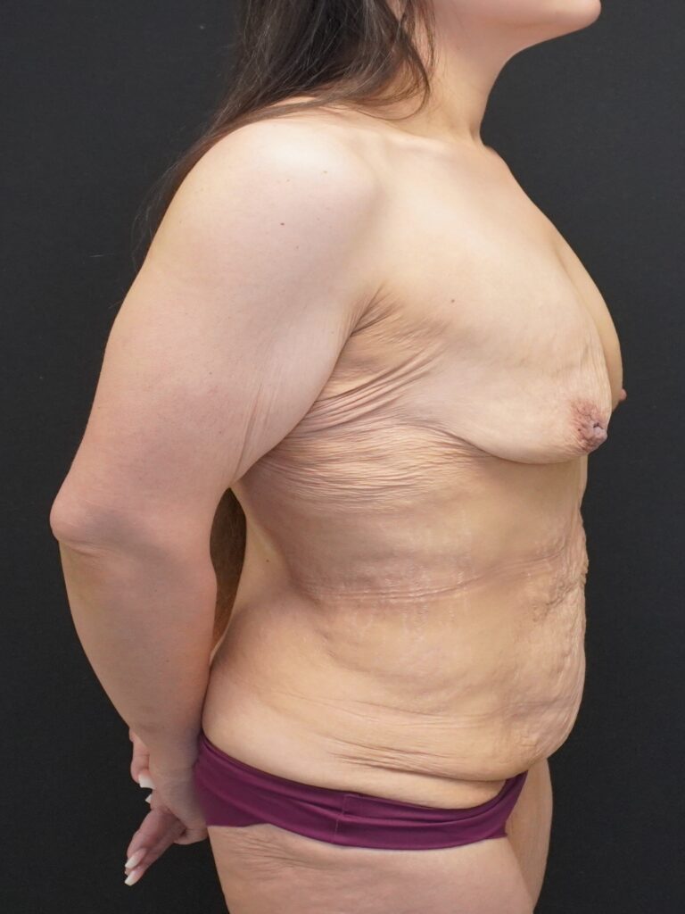 Before Image:  - right-side