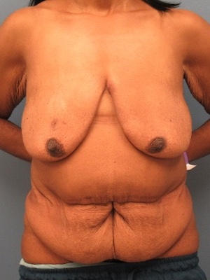 Before Image:  - front