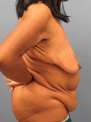 Before Image:  - right-side