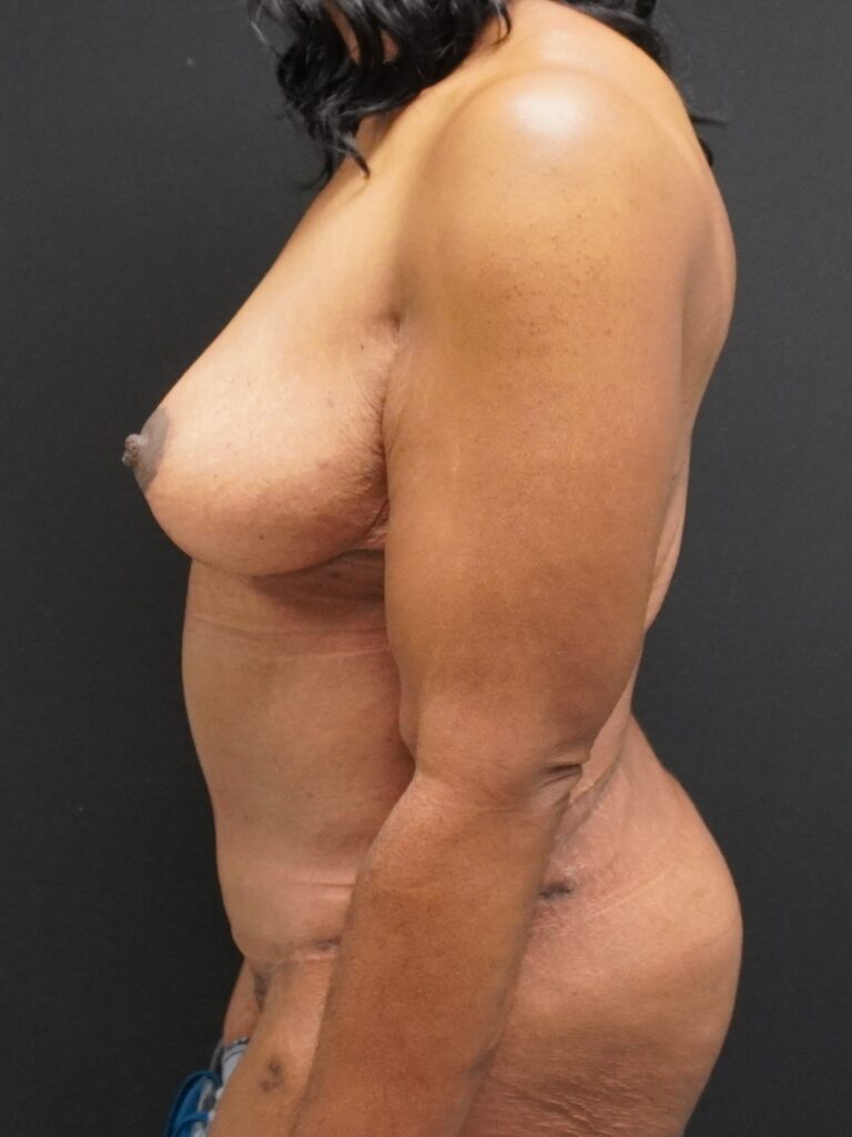 After Image:  - left-side