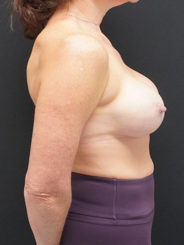 Before Image:  - right-side