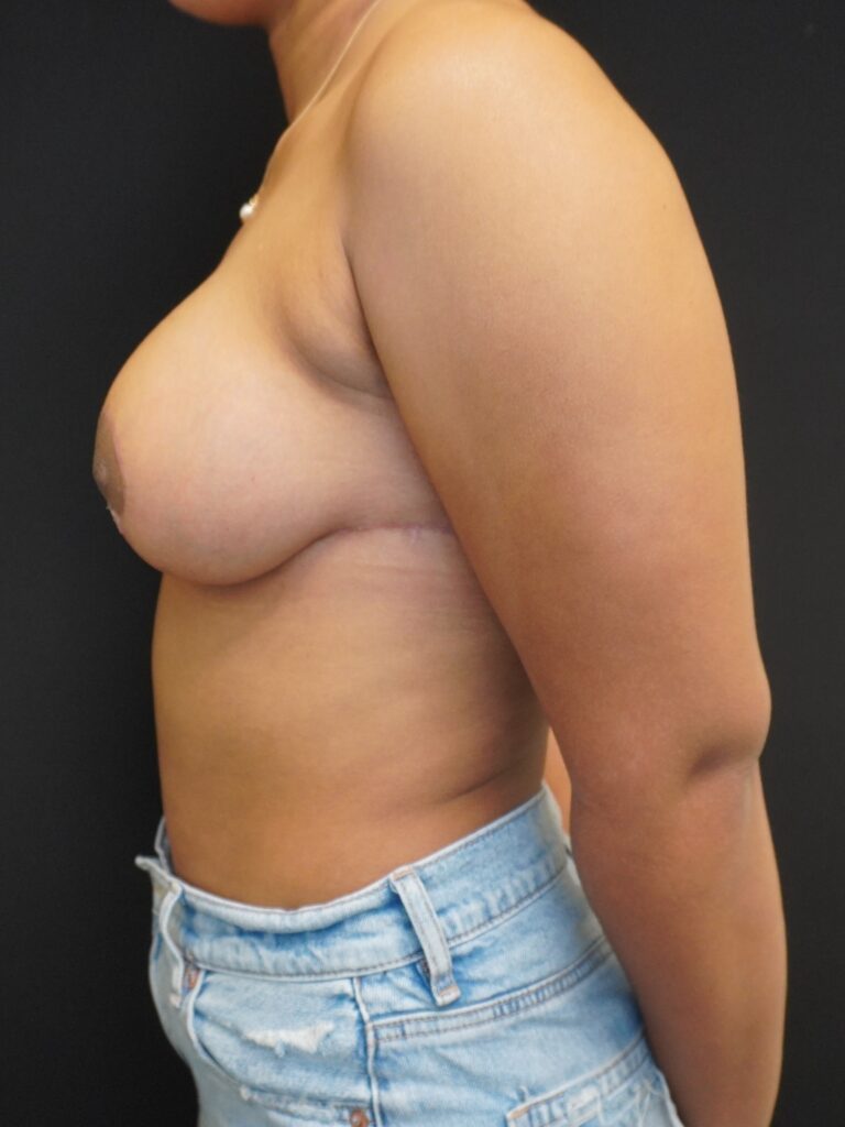 After Image:  - left-side
