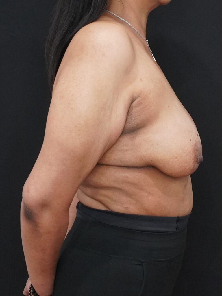 Before Image:  - right-side