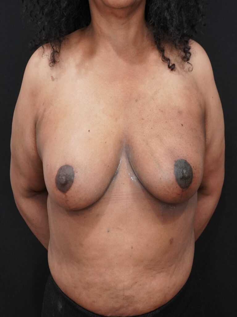 After Image:  - front