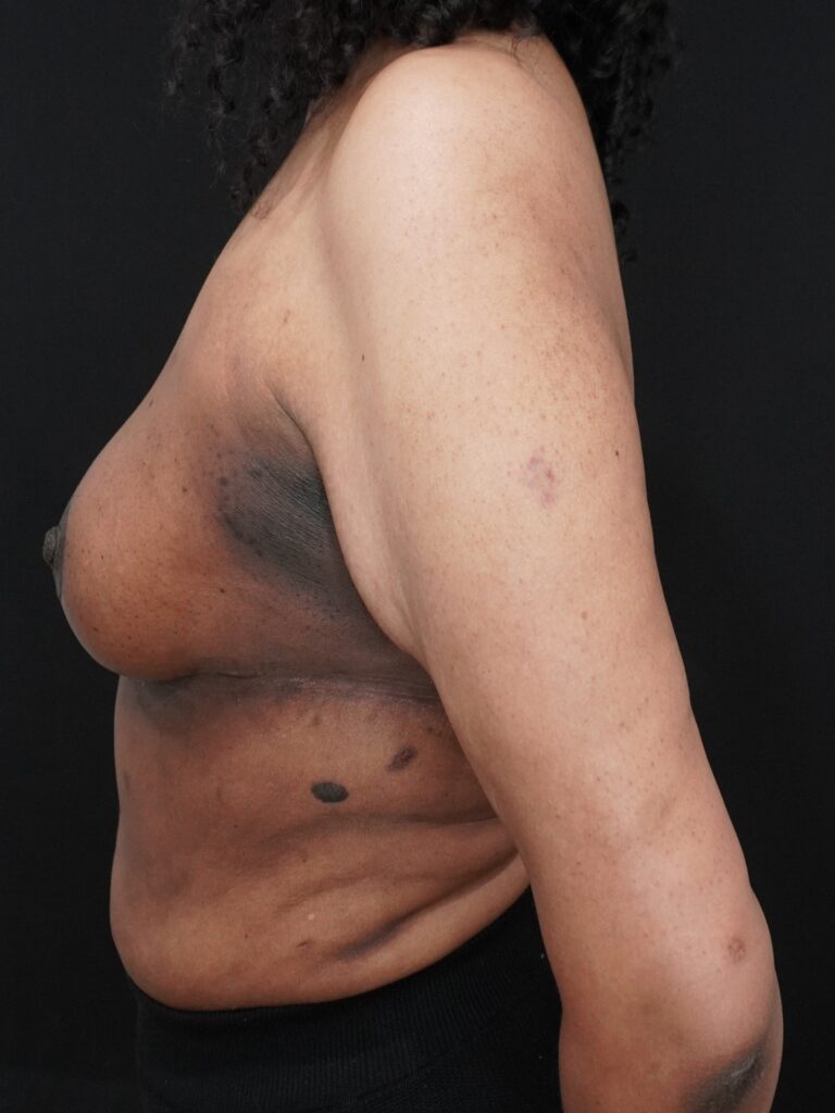 After Image:  - left-side
