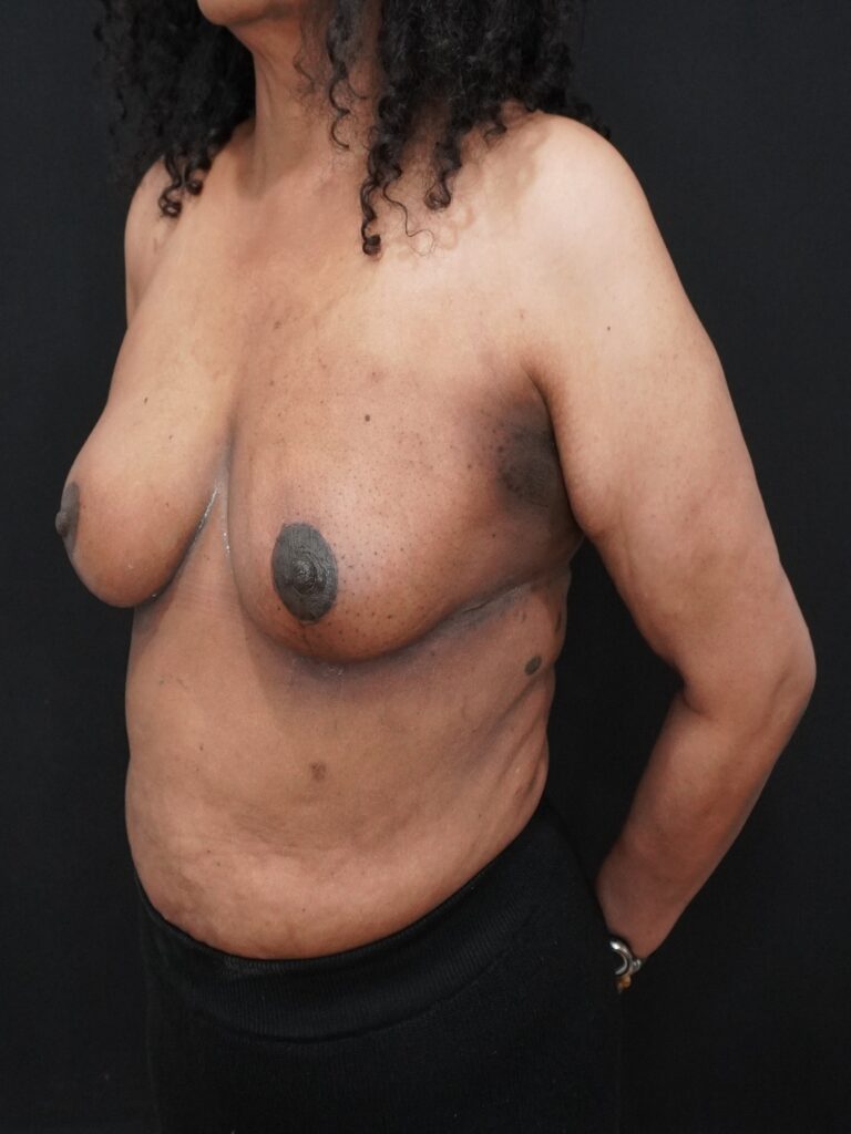 After Image:  - left-front-oblique