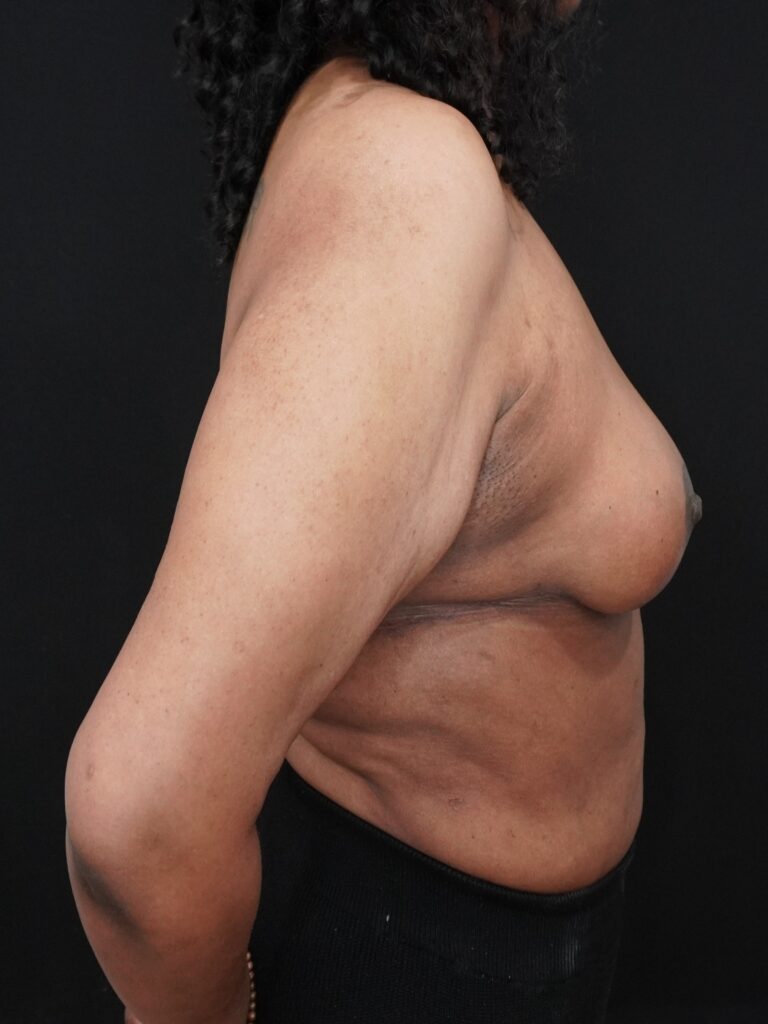 After Image:  - right-side