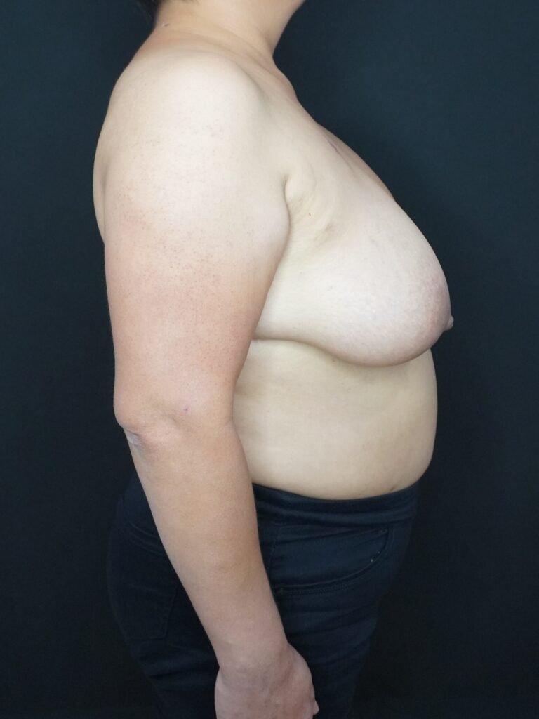Before Image:  - right-side