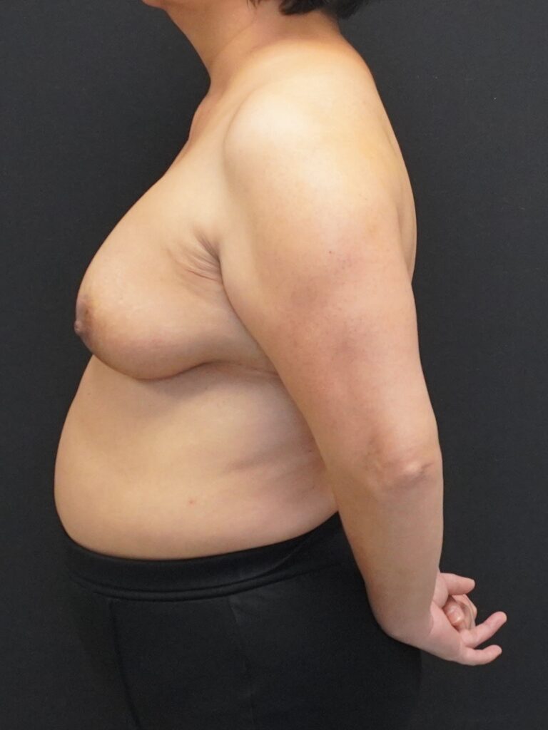 After Image:  - left-side