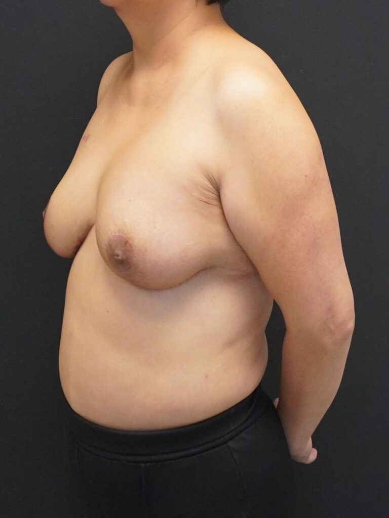After Image:  - left-front-oblique