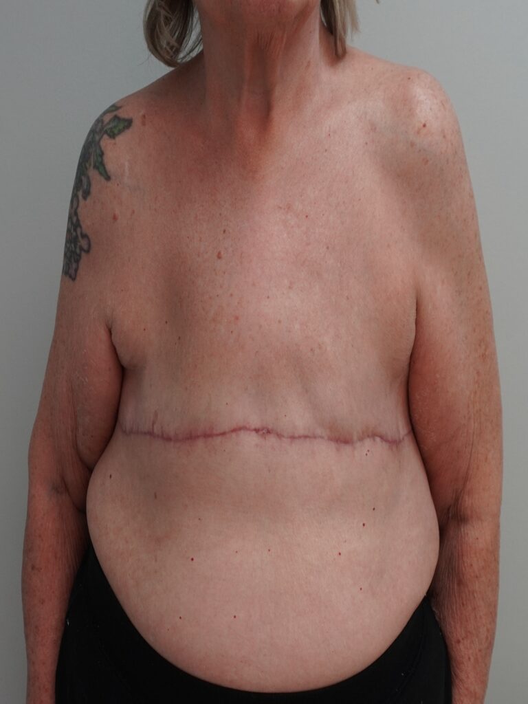 After Image:  - front