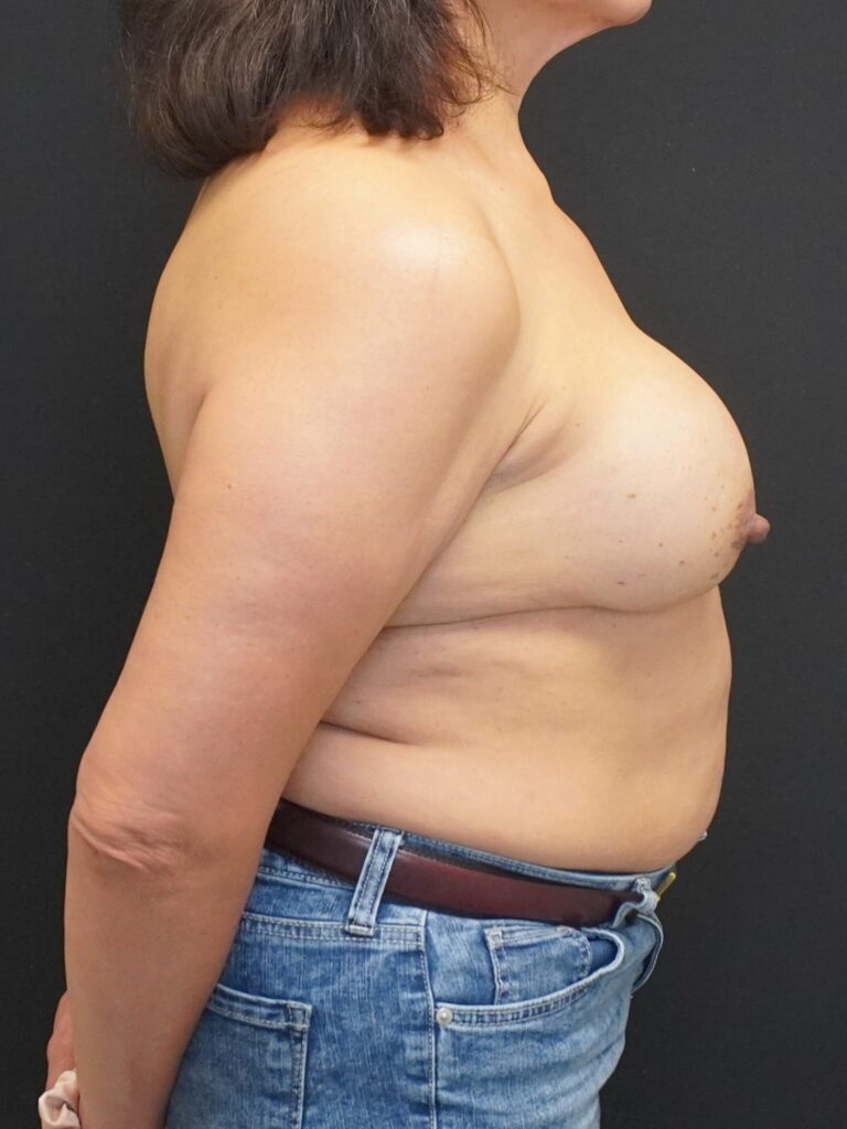 Before Image:  - right-side