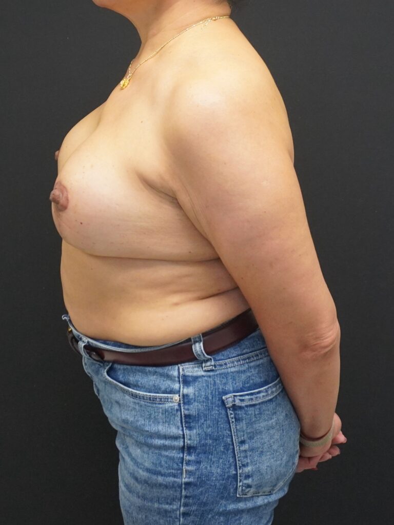 After Image:  - left-side