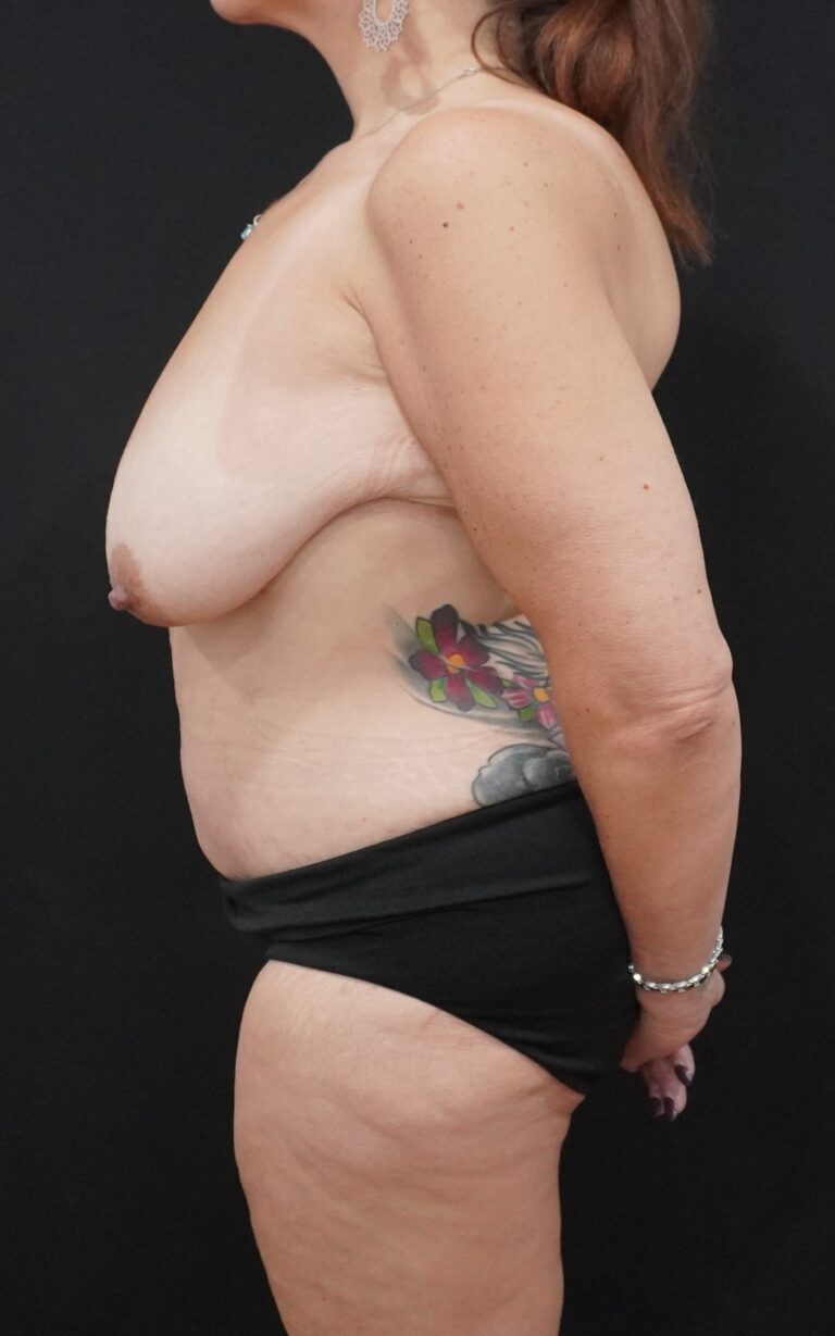 Before Image:  - left-side