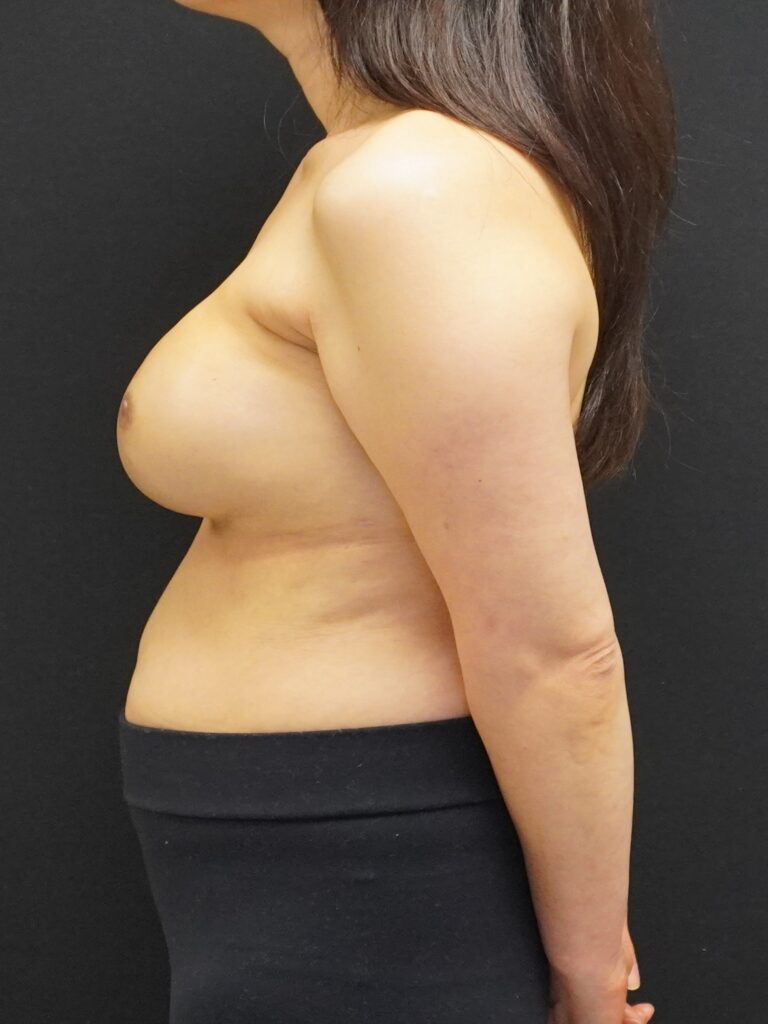 Before Image:  - left-side
