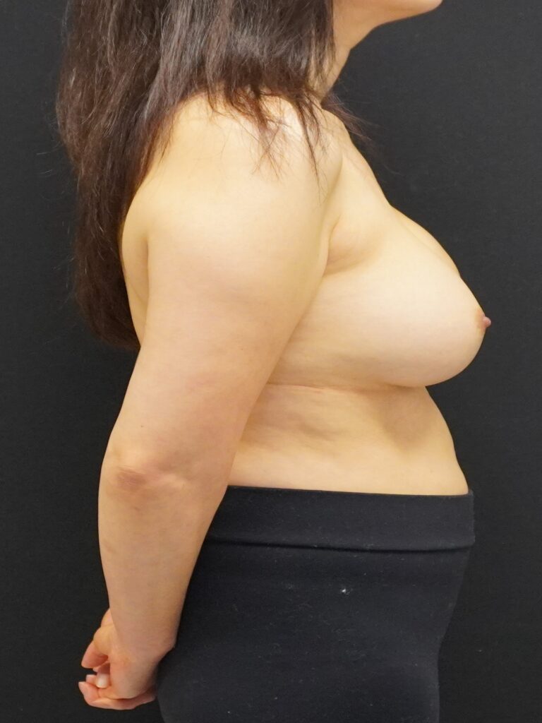 Before Image:  - right-side