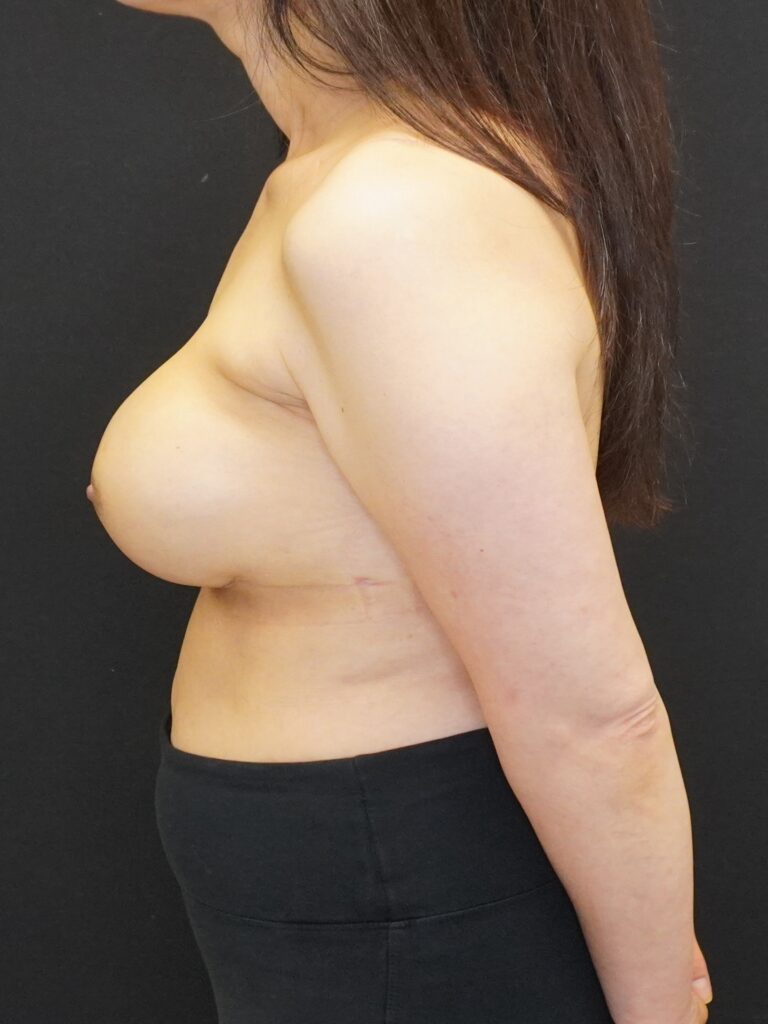 After Image:  - left-side