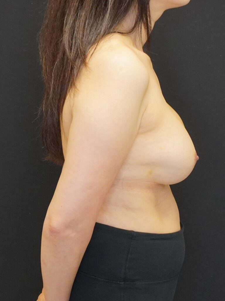 After Image:  - right-side