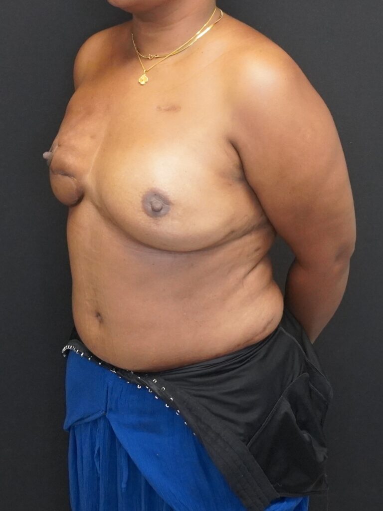 After Image:  - left-front-oblique