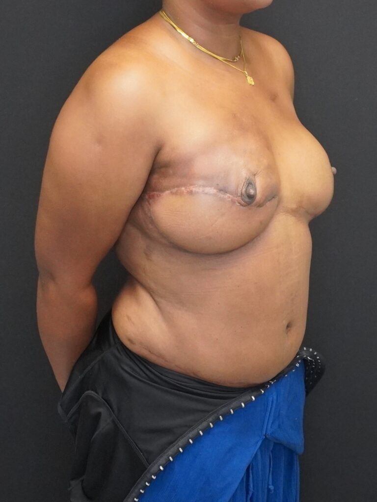 After Image:  - right-front-oblique
