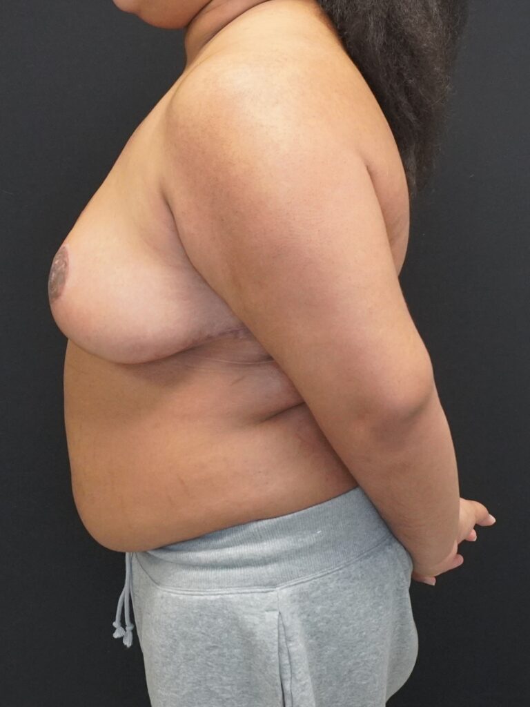 After Image:  - left-side