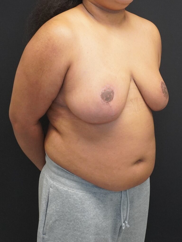 After Image:  - right-front-oblique