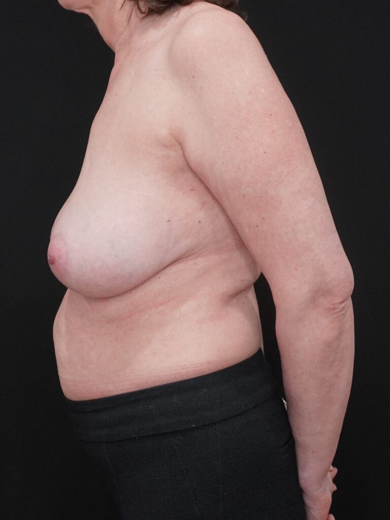 Before Image:  - left-side