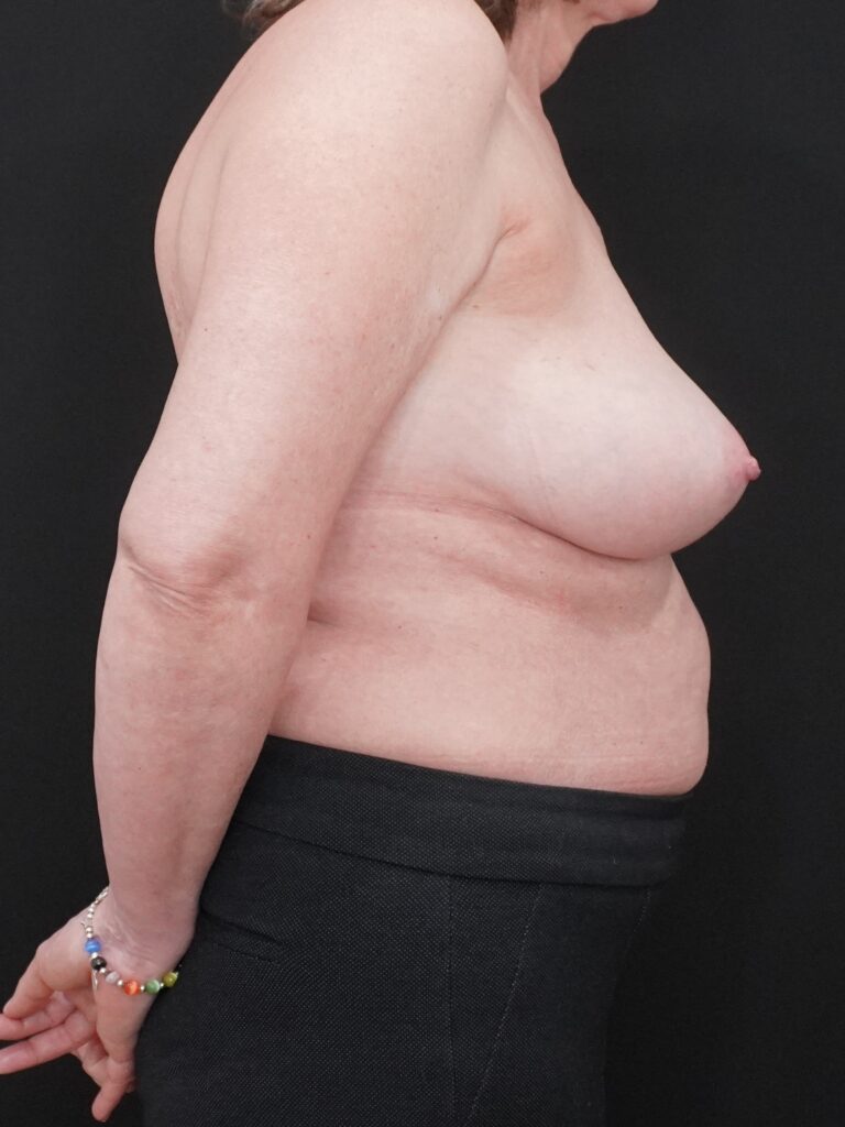 Before Image:  - right-side