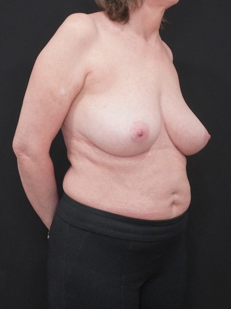 Before Image:  - right-front-oblique