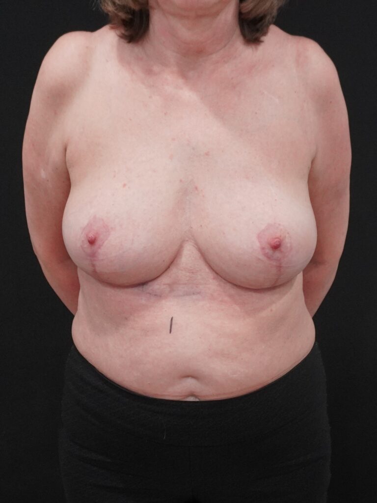 After Image:  - front