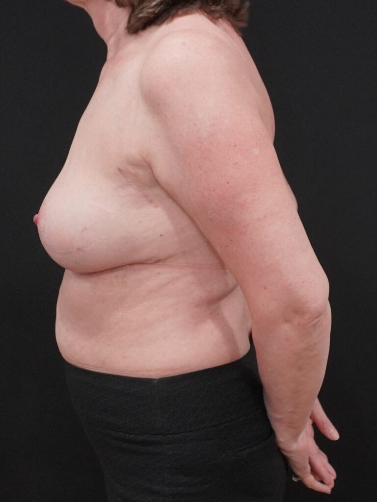 After Image:  - left-side