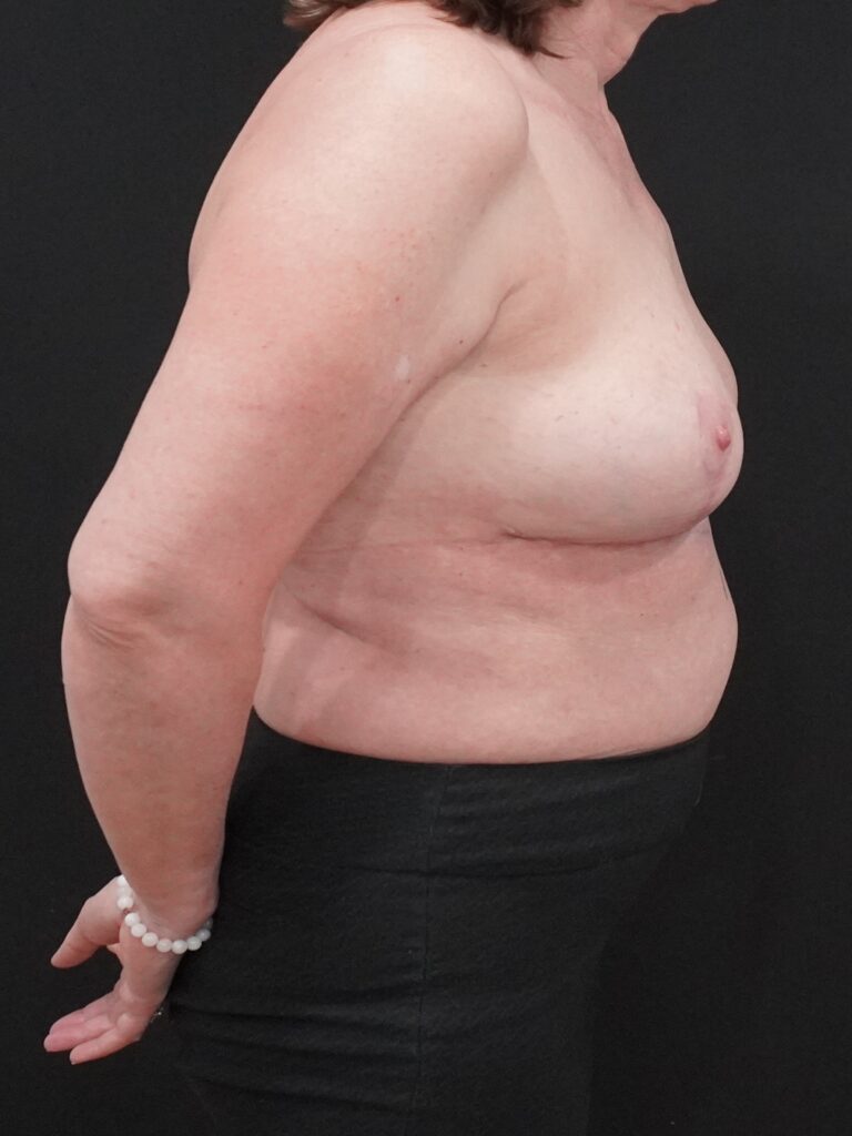 After Image:  - right-side