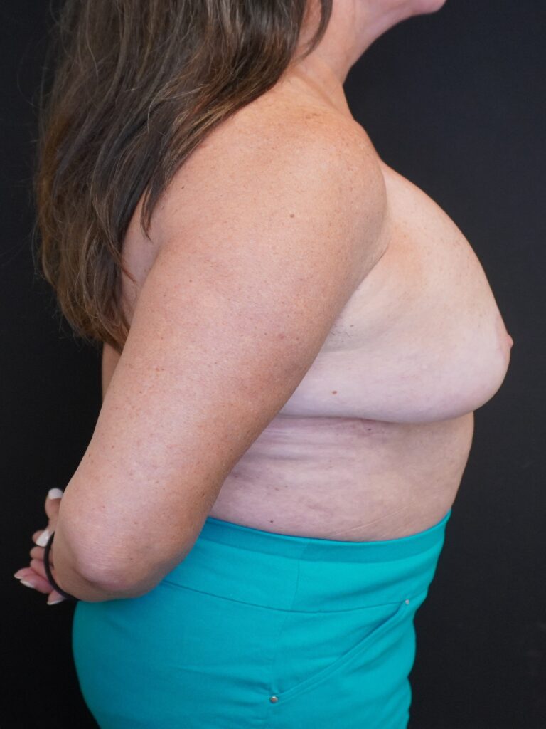 After Image:  - right-side