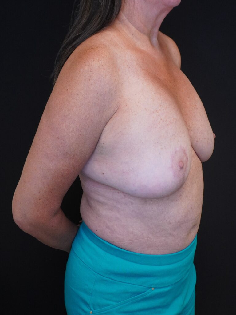 After Image:  - right-front-oblique