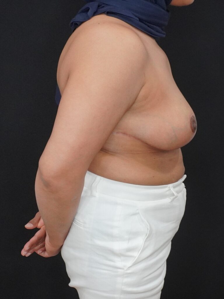 After Image:  - right-front-oblique