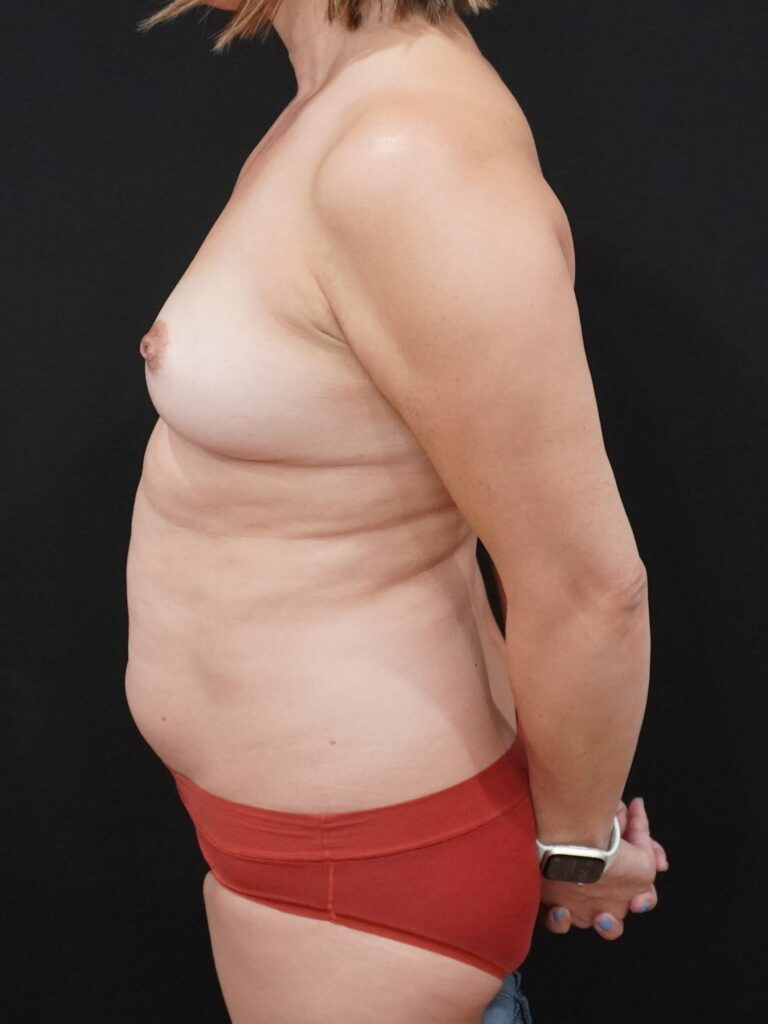 Before Image:  - left-side