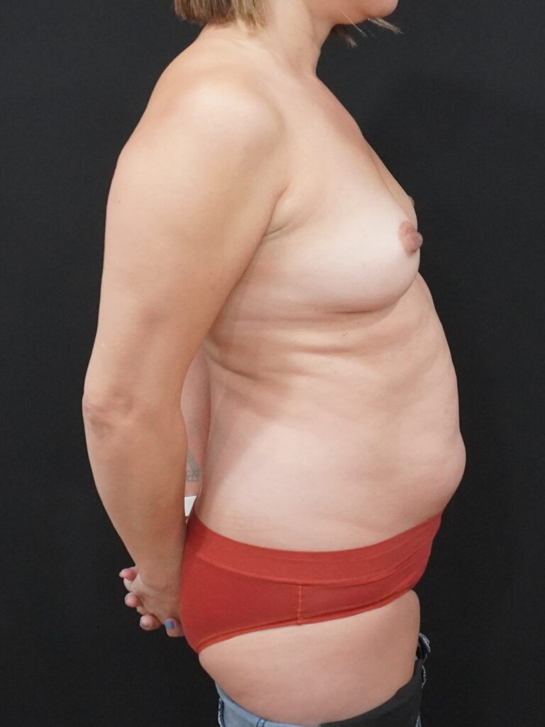 Before Image:  - right-side