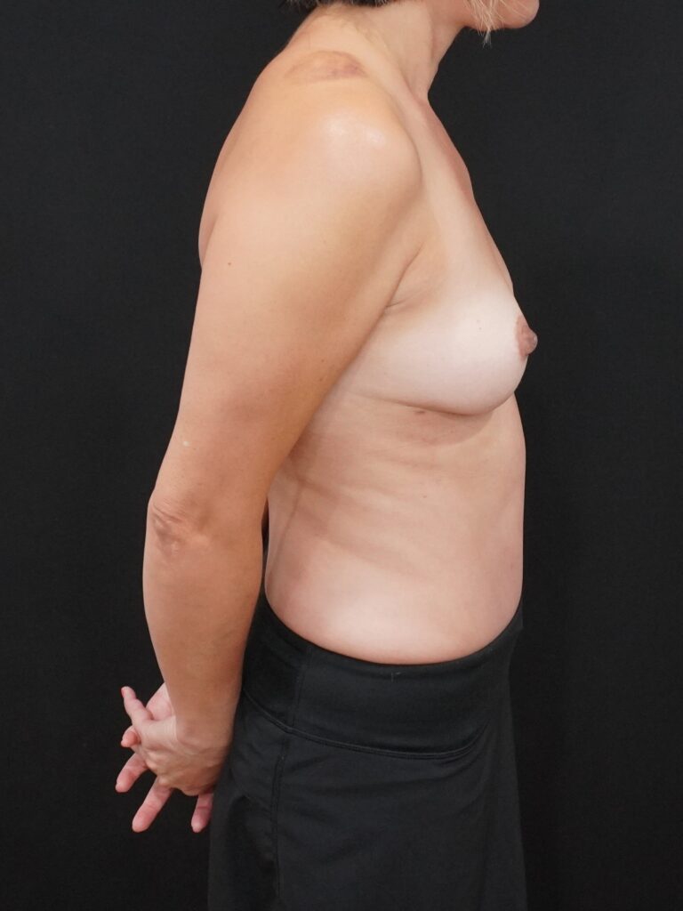 After Image:  - right-side