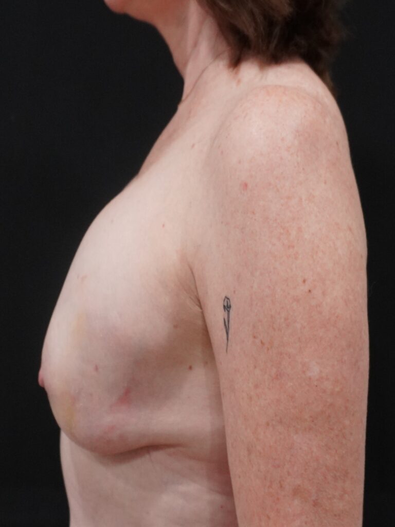 Before Image:  - left-side