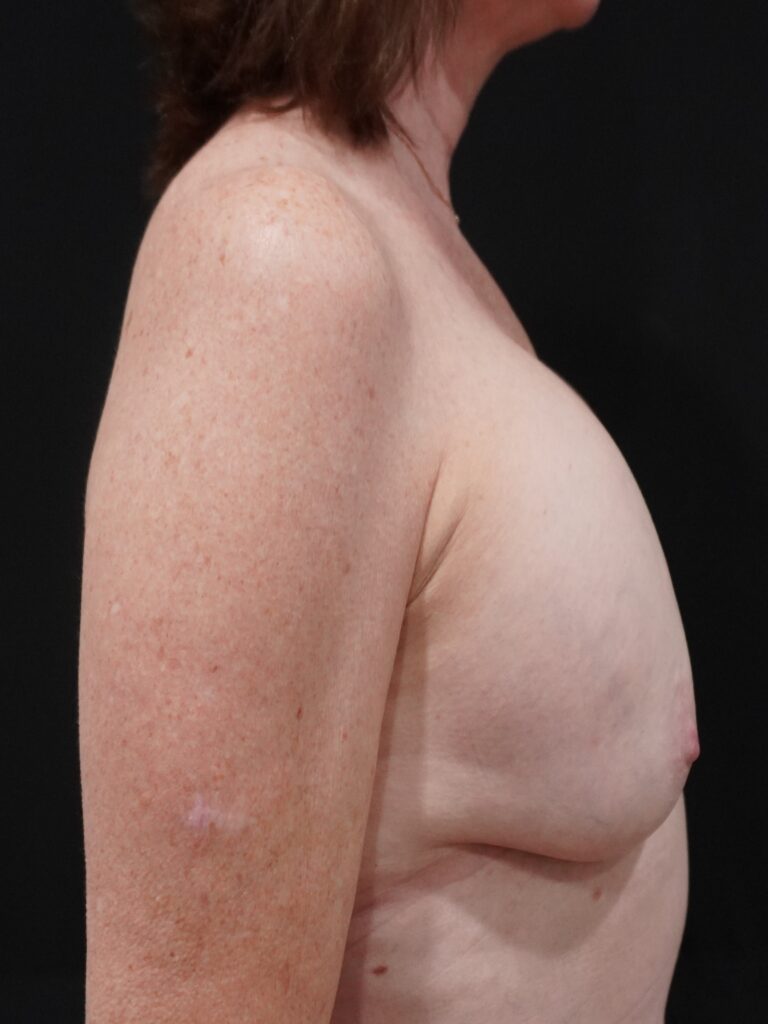 Before Image:  - right-side